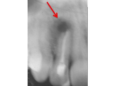 Before Results for Immediate Dental Implants in the Cosmetic Zone