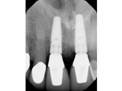 After Results for Immediate Dental Implants in the Cosmetic Zone