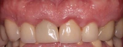 Before Results for Immediate Dental Implants in the Cosmetic Zone