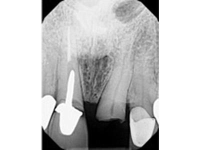 Before Results for Immediate Dental Implants in the Cosmetic Zone