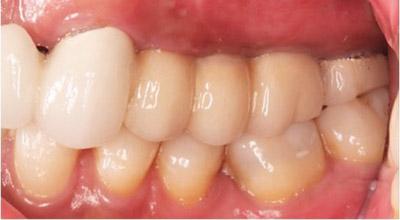 After Results for Dental Implants to Replace Multiple Teeth