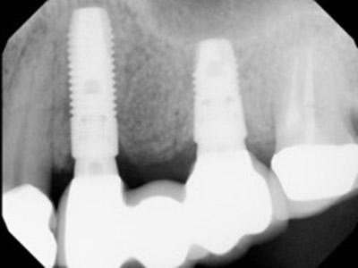 After Results for Dental Implants to Replace Multiple Teeth