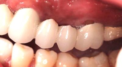 Before Results for Dental Implants to Replace Multiple Teeth