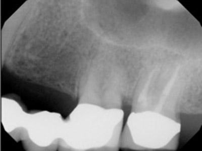 Before Results for Dental Implants to Replace Multiple Teeth