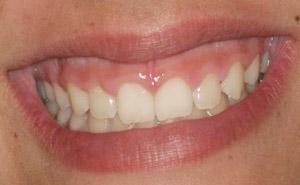 Before Results for Gingival Recontouring