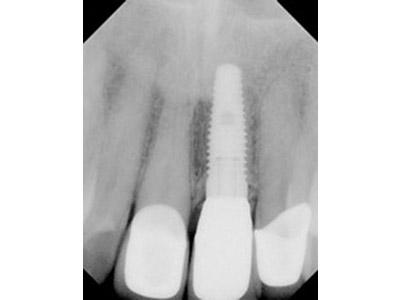 After Results for Immediate Dental Implants in the Cosmetic Zone