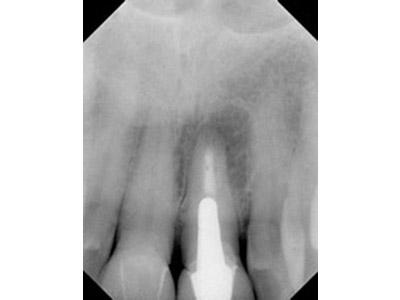 Before Results for Immediate Dental Implants in the Cosmetic Zone