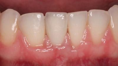 After Results for Immediate Dental Implants in the Cosmetic Zone