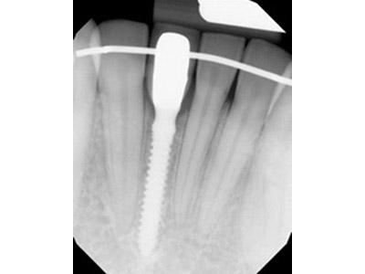 After Results for Immediate Dental Implants in the Cosmetic Zone