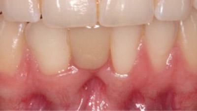 Before Results for Immediate Dental Implants in the Cosmetic Zone