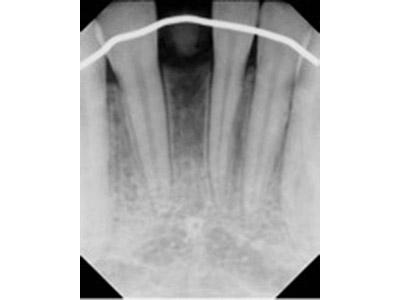 Before Results for Immediate Dental Implants in the Cosmetic Zone