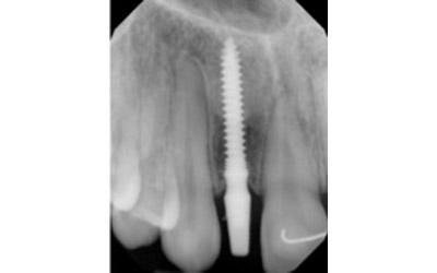 After Results for Immediate Dental Implant Provisionalization