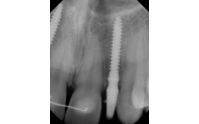 After Results for Immediate Dental Implant Provisionalization