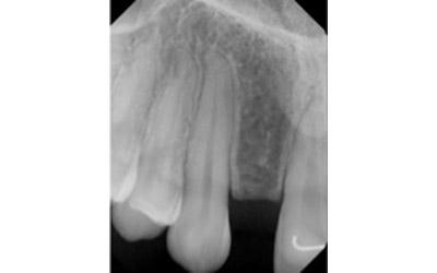 Before Results for Immediate Dental Implant Provisionalization