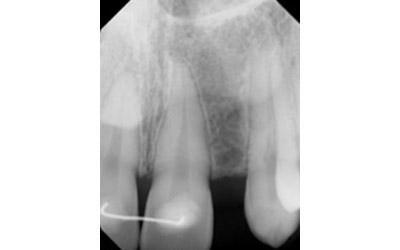 Before Results for Immediate Dental Implant Provisionalization