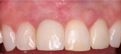 After Results for Immediate Dental Implant Provisionalization