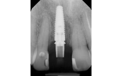 After Results for Immediate Dental Implant Provisionalization