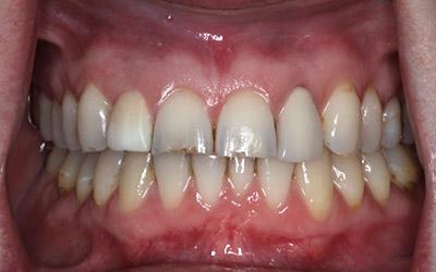 After Results for Immediate Dental Implant Provisionalization