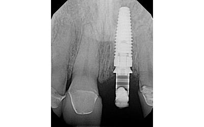 After Results for Immediate Dental Implant Provisionalization