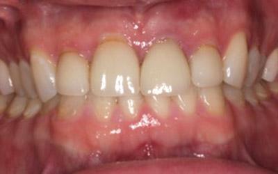 Before Results for Immediate Dental Implant Provisionalization