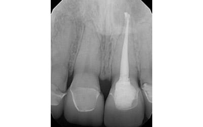 Before Results for Immediate Dental Implant Provisionalization