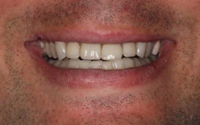 Before Results for Immediate Dental Implant Provisionalization