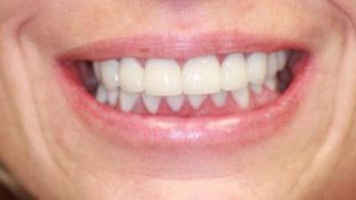 After Results for Rebuilding Your Smile with Collaborative Care