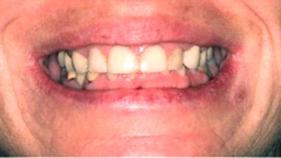 Before Results for Rebuilding Your Smile with Collaborative Care