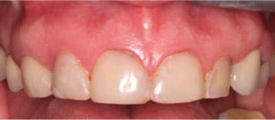 Before Results for Rebuilding Your Smile with Collaborative Care