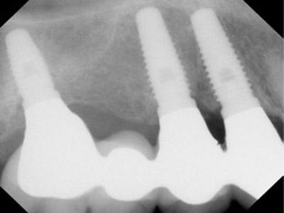 After Results for Dental Implants to Replace Multiple Teeth