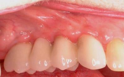 After Results for Dental Implants to Replace Multiple Teeth