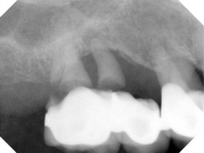 Before Results for Dental Implants to Replace Multiple Teeth