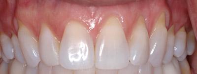 Before Results for Connective Tissue Grafts