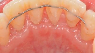 After Results for Connective Tissue Grafts