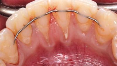 Before Results for Connective Tissue Grafts