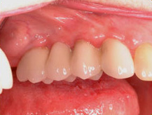 Dental Bridge