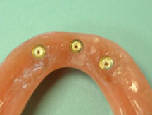 Implant Retained Denture