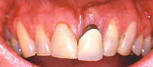 Failing tooth