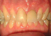 Failing tooth fixed