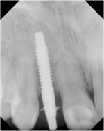 X-ray left