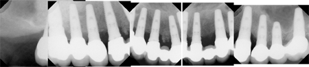 Post-Op X-rays of Final Restoration
