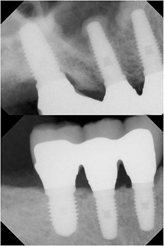 X-ray of Same Bridges 5 Year After Restoration