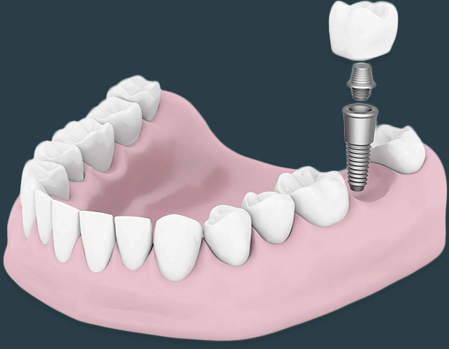 Image of Dental Implants