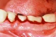 Periodontal disease case