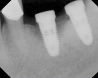 Post-Operative X-ray Showing Failing Implant