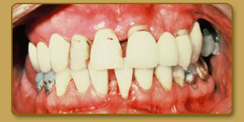 Periodontal disease case