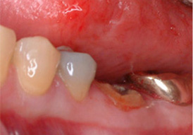 Appearance of the tooth prior to crown lengthening without crown