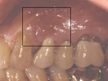 A longstanding root canal infection