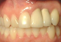 final_rest11 Results from Bone Graft