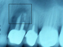 Dark spot around the root of the first bicuspid